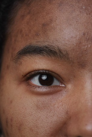 Pigmentatie/ Melasma